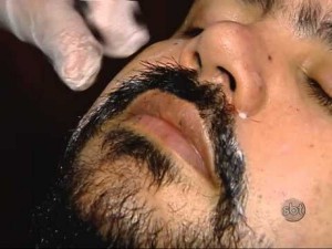 Implantes de barba