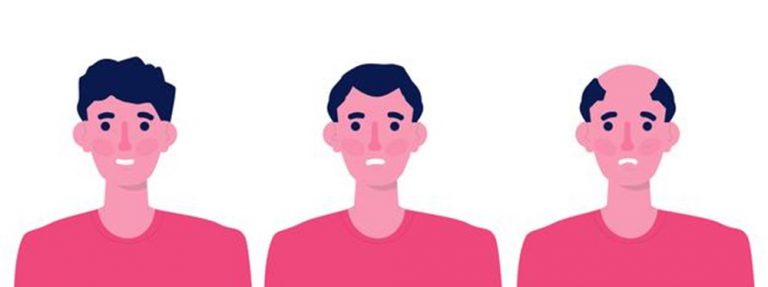 Las principales causas de pérdida de cabello en los hombres