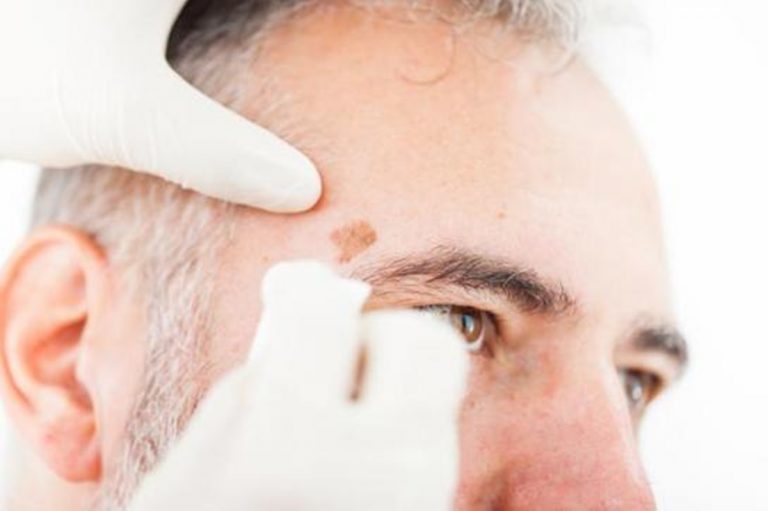 Cómo reducir y eliminar las manchas de la edad de los hombres